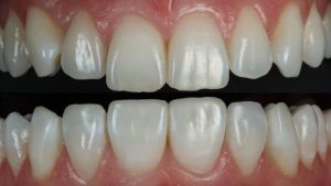 The Psychology of Smiling More Confidently After Composite Bonding Treatment