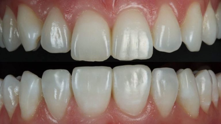 The Psychology of Smiling More Confidently After Composite Bonding Treatment