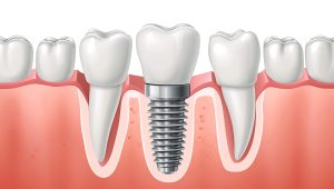 How Ancient Jawbone Studies Inform Modern Dental Implant Placement Techniques