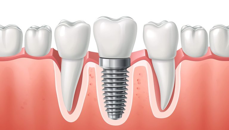 How Ancient Jawbone Studies Inform Modern Dental Implant Placement Techniques